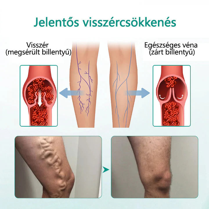 O adesivo para varizes Cvreoz® LegRenew melhora a saúde das veias e elimina as varizes. 🌿Sem agulhas, sem cirurgia, apenas resultados seguros, suaves e eficazes.