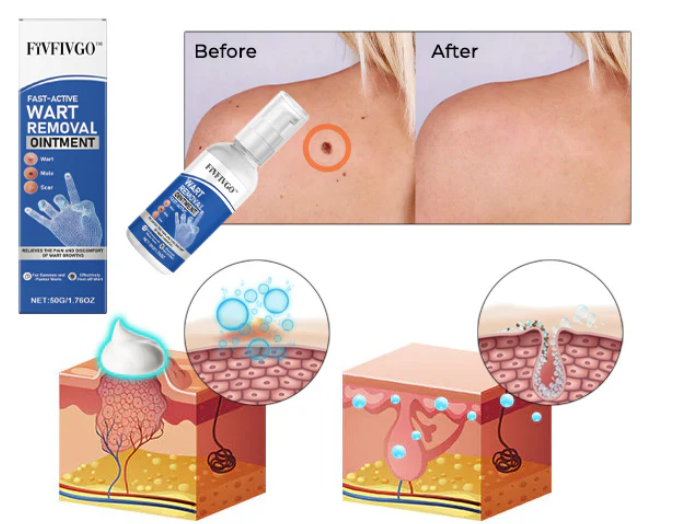 Spray Remove-Wart