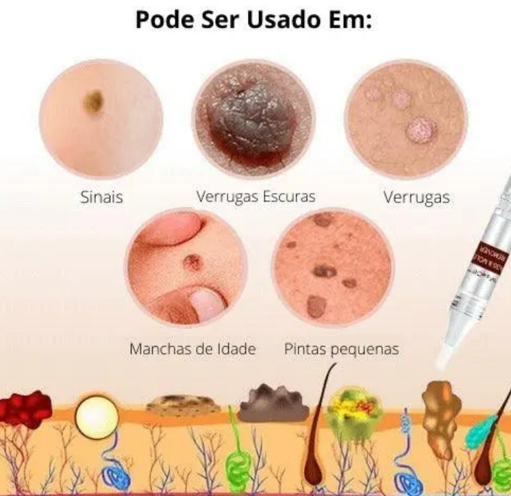 ЕХТЕRМIΝАDОR DЕ VЕRRUGАЅ