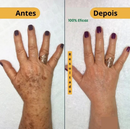 Revitta 577 Spray - Remove manchas de SOL, IDADE E MELASMA!